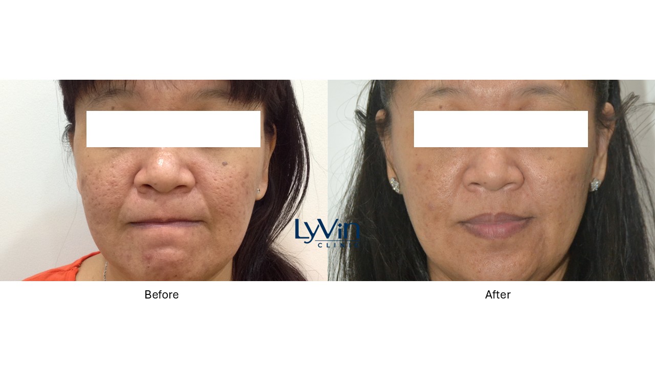 Visible skin texture improvement with ECO2 Laser before vs after